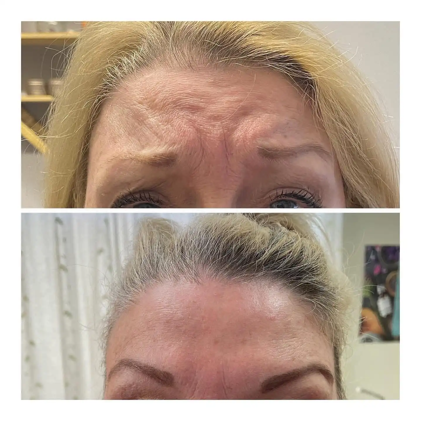 Botox before and after pictures - The Beautique, West Runton, Cromer-5 Botox Before and after images - The Beautique West Runton Cromer