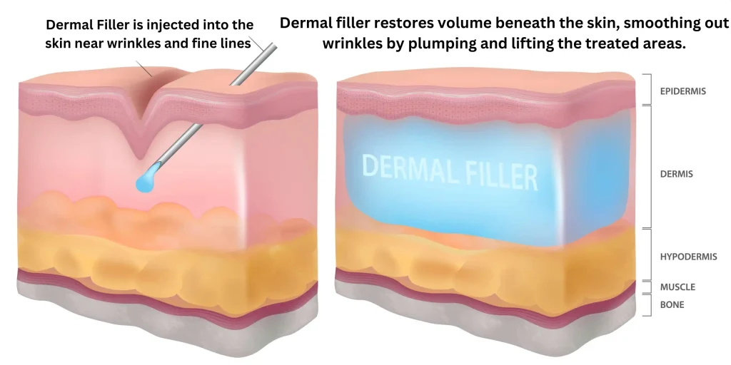 How Dermal Fillers work under the skin