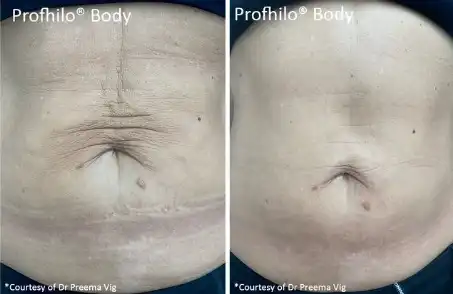 Profhilo Skin Boosters before and after